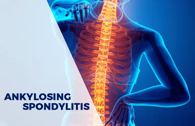 Ankylosing Spondylitis