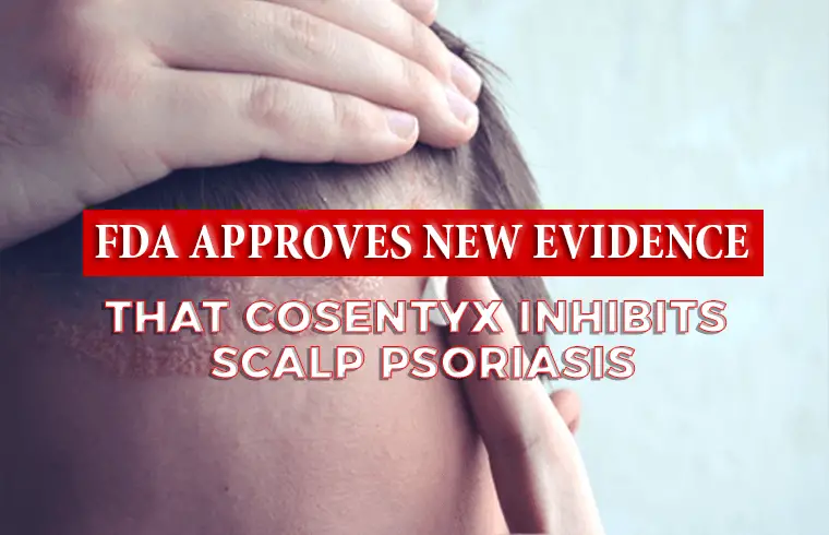 Photo of FDA APPROVES NEW EVIDENCE THAT COSENTYX® INHIBITS SCALP PSORIASIS
