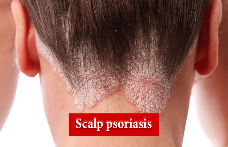 Scalp psoriasis