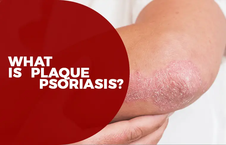 Plaque Psoriasis