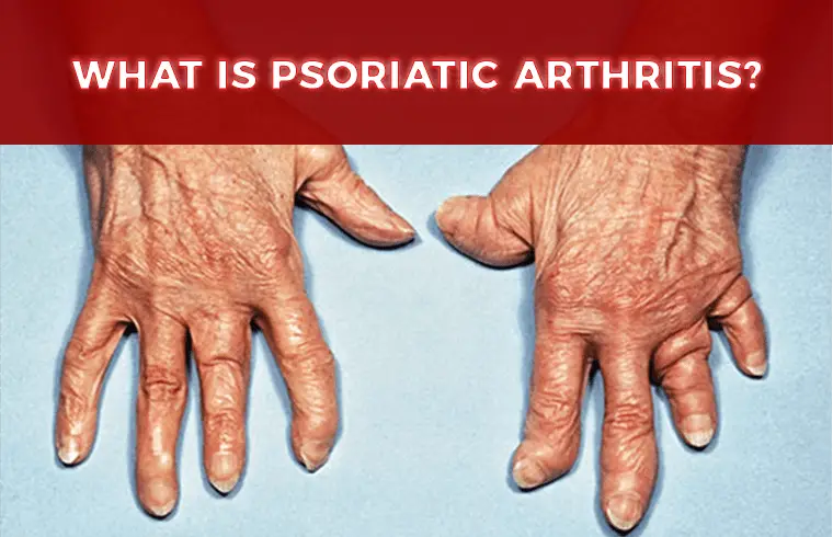 Psoriatic Arthritis