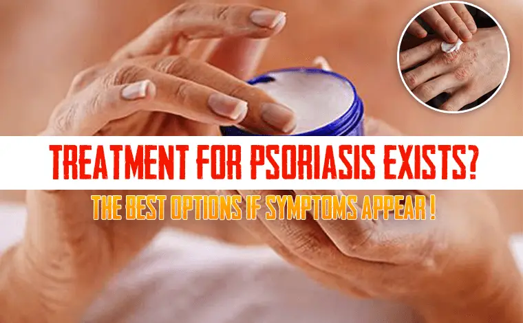 Treatment for psoriasis exists?
